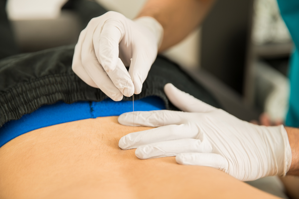 Dry needling: What you didn’t know you were missing